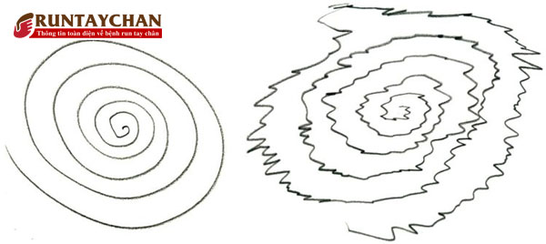 Người bệnh run vô căn khó vẽ được một hình tròn xoáy ốc (hình bên trái) mà vẽ thành hình răng cưa (bên phải)